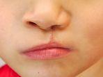 ilustrasi-bibir-sumbing-untuk-sido-muncul.jpg