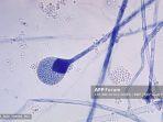 ilustrasi-infeksi-jamur-mucor-sp-zygomycosis.jpg
