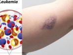 ilustrasi-leukemia.jpg