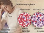 Anak Penderita Leukemia Bisa Sembuh Jika Cepat Penanganan Medisnya