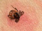 ilustrasi-lyme-disease1.jpg