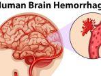 ilustrasi-pendarahan-otak-atau-brain-hemorrhage-7463753.jpg