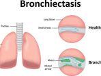 ilustrasi-penyakit-bronkiektasis.jpg