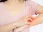 ilustrasi-ringworm-pada-tangan-2.jpg