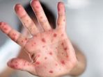 ilustrasi-rubella_20180906_105317.jpg