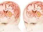 ilustrasi-tumor-otak-9.jpg
