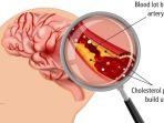 infark-serebral-stroke-ilustrasi-stroke.jpg