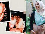 irish-bella-keguguran-di-kehamilan-27-week.jpg