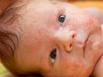 jerawat-bayi_20180808_134250.jpg