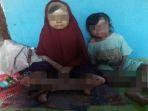 kakak-beradik-penyakit-aneh1.jpg