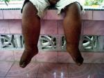 kaki-gajah-penderita.jpg