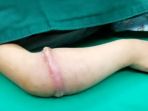 karet-gelang-masuk-ke-dalam-kulit_20180502_174551.jpg