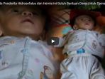 kasihan-balita-penderita-hidrosefalus-dan-hernia-ini-butuh-bantuan-dana-untuk-operasi_20171106_114233.jpg