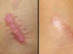 keloid123.jpg