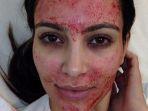 kim-kardashian-lakukan-perawatan-vampire-facial.jpg