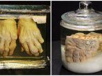 kolase-koleksi-awetan-di-mutter-museum-amerika-serikat.jpg