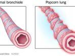 kondisi-saluran-paru-paru-penderita-popcorn-lung-karena-rokok-elektrik.jpg