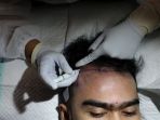 Banyak Artis Ikuti Tren Transplantasi Rambut Demi Penampilan, Aman atau Tidak?