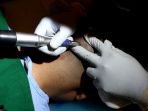 Bisa Dilakukan di Indonesia, Cek Biaya yang Harus Dikeluarkan untuk Transplantasi Rambut  