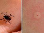 lyme-disease.jpg