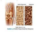 matriks-tulang-normal-dan-osteoporosis.jpg
