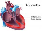 myocarditis_20150211_105442.jpg