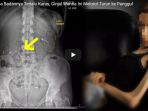 ngeri-karena-badannya-terlalu-kurus-ginjal-wanita-ini-melorot-turun-ke-panggul_20180425_113516.jpg