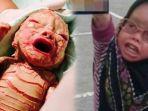 nurfarisha-dania-kanan-dan-potret-bayi-penderita-kulit-mengelupas.jpg
