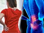 Ahli Medis Kini Pakai Metode Minimally Invasive Spine Surgery Atasi Low Back Pain