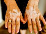 pasien-penderita-vitiligo.jpg