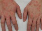 penyakit-kulit-dermatitis111.jpg