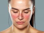 Mengenal Gejala Lupus yang Bisa Menyerang Berbagai Organ Tubuh, Mulai Bercak Kulit Hingga Sariawan