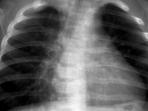 pneumonia-paru-paru-basah_20141117_173934.jpg