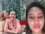 putri-farida-nurhan-kini-alami-infeksi-hingga-bengkak.jpg