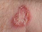 ringworm-atau-kurap-healthline.jpg