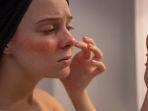 rosacea_5.jpg