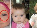 seorang-anak-perempuan-pengidap-retinoblastoma.jpg