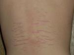 stretch-mark-kulit.jpg