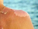 sunburn1.jpg