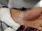 tangan-nur-filzah-setelah-terbakar_20180925_184133.jpg