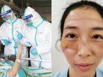 Di Balik Masker Pelindung Dokter yang NonStop Tangani Pasien Virus Corona, Terbongkar Wajah Pilu Ini