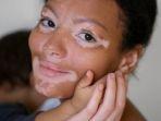 vitiligo-1.jpg