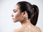 vitiligo-ilustrasi.jpg