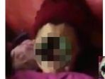 wajah-seorang-wanita-yang-digerogoti-penyakit-langka_20171101_204102.jpg