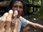 warga-luka-melepuh_20170121_100020.jpg