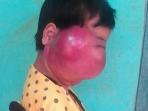 yuniar-tri-andini-bocah-10-tahun-pengidap-tumor-ganas_20160715_194042.jpg