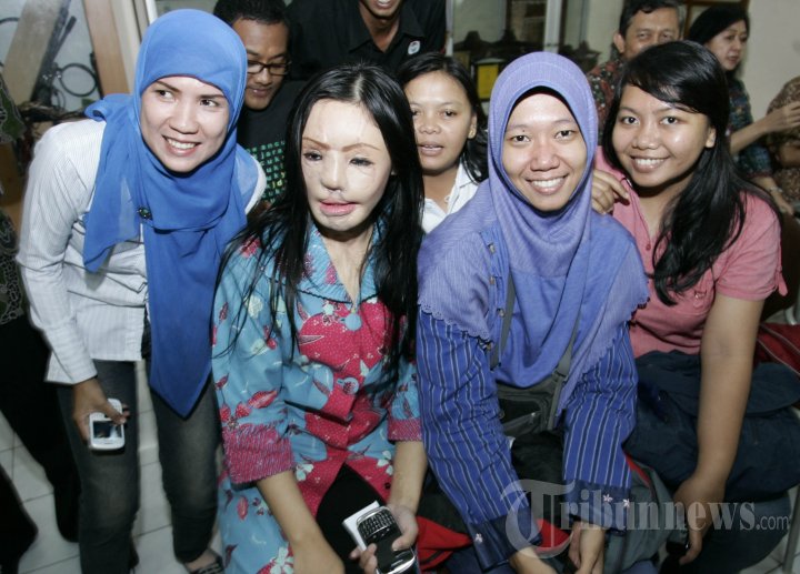 Lisa Pasien Face Off Dilepas RSU dr Soetomo