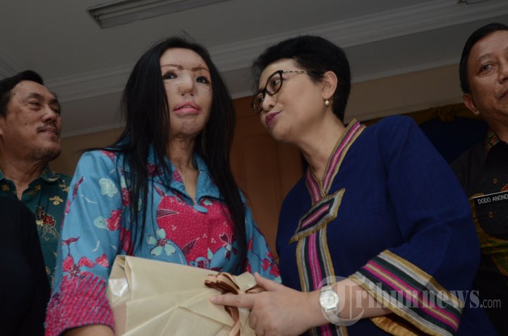 Lisa Pasien Face Off Dilepas RSU dr Soetomo