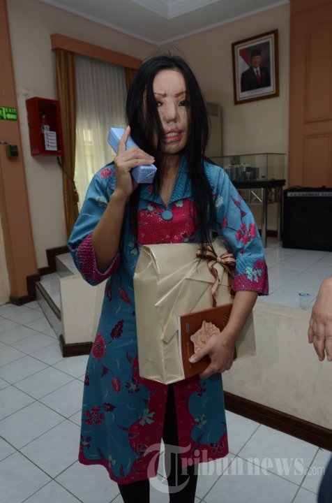 Lisa Pasien Face Off Dilepas RSU dr Soetomo