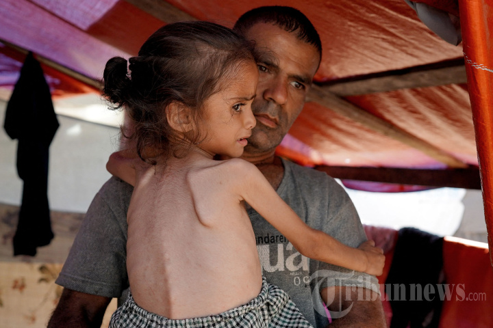 Anak Gaza Kekurangan Gizi di Tengah Serangan Israel